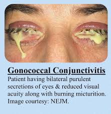Image result for Gonococcal Conjunctivitis