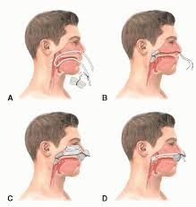 Image result for Nasal Packing