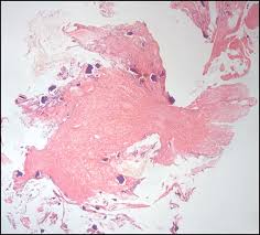 Image result for Kayexalate