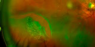 Operculated retinal tear an operculated tear results from vitreous traction that pulls a plug of sensory retina out into the vitreous cavity (see illustration). Looming Myopia Problem An Ophthalmologist S Perspective Optometry Australia