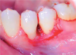 Image result for granuloma gum disease
