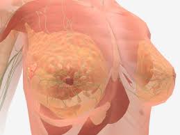 Stage 4 Breast Cancer Symptoms And Prognosis