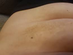 Was Sind Diese Braune Flecken Haut