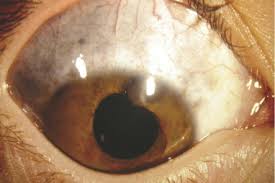 Image result for melanosis sclera