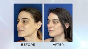 Facial Feminization Surgery San Francisco | Bay Area Facial Feminization