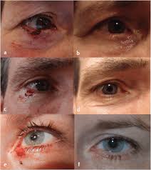 Image result for Eyelid Closure Defect