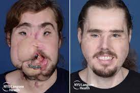 NYU Performs Its 2nd Face Transplant on Cameron Underwood | Time