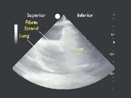 Pleural fluid is seen extending to the right oblique fissure. Ultrasound Of A Loculated Pleural Effusion This Ultrasound Was Taken Download Scientific Diagram