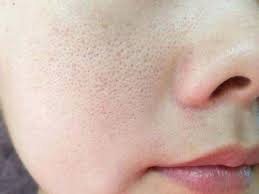 Khasiat putih telur yang pertama dapat membantu menghilangkan jerawat. Atasi Jerawat Hingga Cegah Penuaan Dini Ini 7 Manfaat Masker Putih Telur Untuk Kecantikan