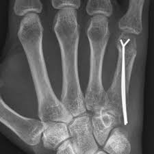Bruche Der Finger Und Mittelhandknochen Behandlung Ksw