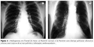 Jornal Brasileiro De Pneumologia Radiograma De Torax E Tomografia Computadorizada Na Avaliacao Do Enfisema Pulmonar