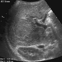 It is one of the most common causes of neonatal. 70 Biliary Atresia Radiology Key