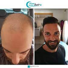 Trapianto di capelli in turchia con tecnica fue: Trapianto Capelli In Turchia Dr Serkan Aygin