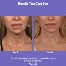 ActivLift™ Neck Lifting Device