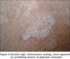 Desquamation (skin coming off in scales) psoriasiform (large white or silver flakes) pityriasiform (branny powdery scale) lichenoid (apparent scale is tightly adherent to the skin surface) keratotic (horny scale) exfoliation (peeling skin) maceration (moist peeling skin) verrucous (warty). Indian Journal Of Dermatology Venereology And Leprology Scaly Signs In Dermatology