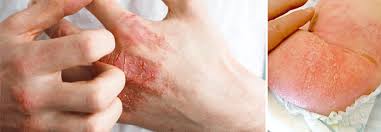 Prevalence of asthma in patients with atopic dermatitis: Atopische Dermatitis Soll Sich Vom Pruritus Verabschieden Medical Tribune