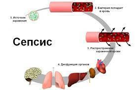Симптомы золотистого стафилококка в кишечнике у взрослых. Sepsis Prichiny Simptomy I Lechenie V State Flebologa Fajzullina A Z