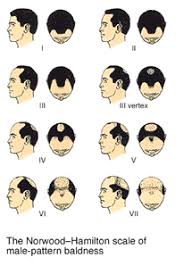 Mens Hair Loss Faq Embassy Studio And Med Spa