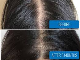 The researcher found that women who took an mps experienced a significant. A Closer Look At Biotin For Hair Growth Results Lewigs