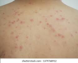 Image result for sweat rash on back