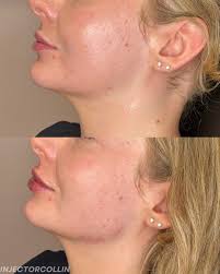 We did the WORKS today—full face tox, trap tox, masseter tox, half syringe  of Kysse, and subtle jawline enhancement. We wanted to add a little more  definition at her gonial angle (back