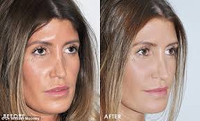 Please look carefully at the postoperative images. One Bondi Surgeon Is Performing Lunch Break Nose Jobs Express Digest