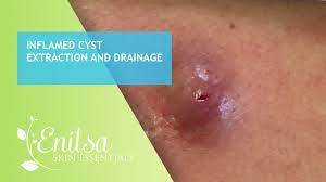 How to drain a cyst with no head. Inflamed Cyst Extraction And Drainage Youtube