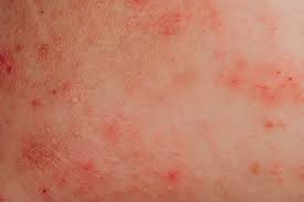 Best itching medicine for rashes and skin irritation and fungal infections. Itchy Skin 14 Causes Pictures And Treatments