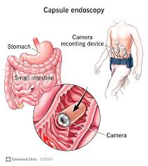 Capsule endoscopy