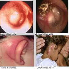 Image result for Mastoiditis