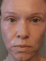 The Better Blepharoplasty