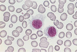 Check spelling or type a new query. Leukemia Definition Of Leukemia By Medical Dictionary