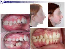 Check spelling or type a new query. Overbite Correction In Houston And Sugarland Tx
