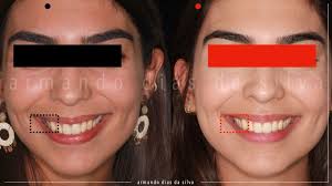 dsxpander #armando #naicbucbct #naicbu #orthodontics…