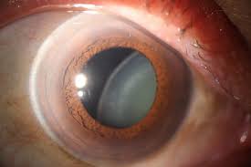 Image result for Lens Dislocation