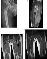 This means that a tiny amount of a radioactive substance is used during the procedure to assist in the bone scans are used primarily to detect the spread of metastatic cancer. Bone And Soft Tissue Tumors Of Hip And Pelvis Sciencedirect