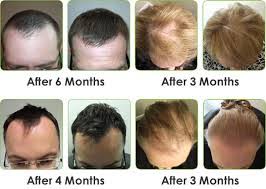To date, there's only limited evidence to suggest that increased biotin intake may help promote hair growth. Does Biotin Help Hair Grow New Health Advisor