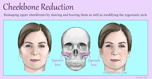 In the human skull, the zygomatic bone (cheekbone or malar bone) is a paired irregular bone which articulates with the maxilla, the temporal bone, the sphenoid bone and the frontal bone. Cheekbone Reduction Pinkmirror Blog