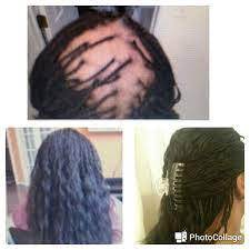 Micro Braids Over A Bald Spot Micro Braids Braids Hair Styles