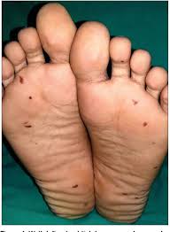 Image result for brown patches on the feet