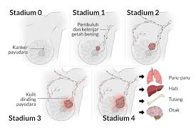 Barah payudara merupakan pembunuh utama kaum hawa dengan hampir separuh dari wanita yang di diagnosis mengidap kanser payudara. Kanker Payudara Gejala Penyebab Dan Mengobati Alodokter
