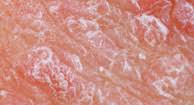 Kidney Failure Causes Types And Symptoms