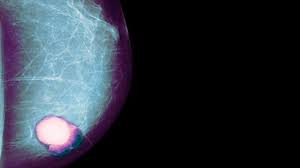 Roi, feature selection and classification of cancer stages in abnormal mammograms. Breast Cancers Diagnosed Between Mammograms Are More Aggressive Everyday Health