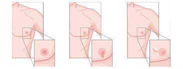 What are the signs and side effects of breast cancer? Breast Cancer Not Just A Female Disease Breast Cancer Now