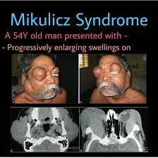 Image result for Sialoadenitis