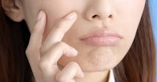 Estos efectos secundarios que se producen dentro de un día o dos, indican la respuesta del cuerpo al botox y no son una causa de preocupación. Riesgos Efectos Secundarios Y Precauciones De La Inyeccion De Botulinum Que Se Puede Esperar Que Kirei