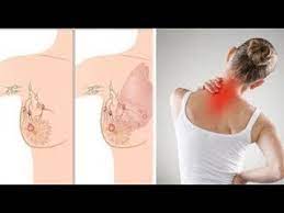 انتبهي هذه هي أول أعراض سرطان الثدي التي يتجاهلها الكثيرون youtube