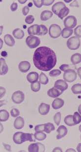An overview of symptoms, genetics, and treatments to help you understand hemophilia a. Wat Is Hemofilie Pfizer