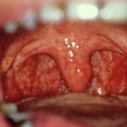 Check spelling or type a new query. Normal Throat And Tonsils Photograph By Cnri Science Photo Library