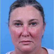 Facelift Before and After